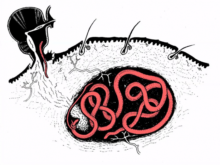 Onchocerca__Beitrag_Alfons_Renz_2